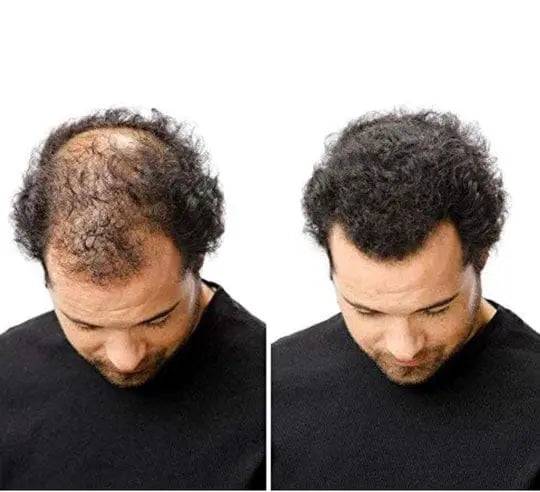 Hair loss treatment, Dexe Hair Building Fibers – Instantly Thicken Thin Hair for Men & Women